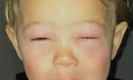 Allergie: een walnoten-kusje van mama is voldoende