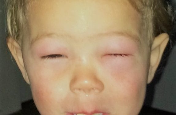 Allergie: een walnoten-kusje van mama is voldoende