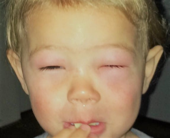 Allergie: een walnoten-kusje van mama is voldoende
